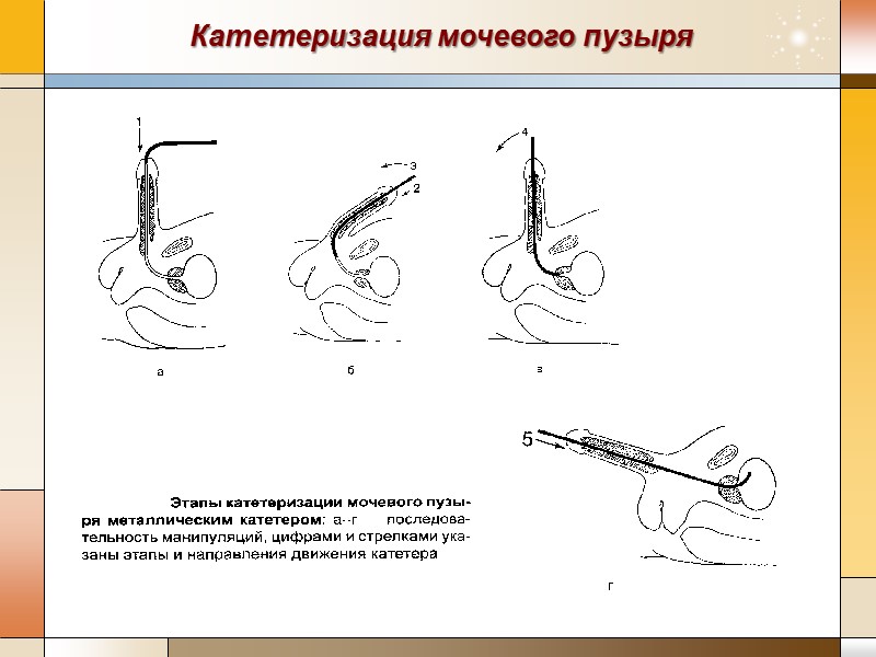 Катетеризация мочевого пузыря